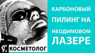 Карбоновыи пилинг на неодимовом лазере
