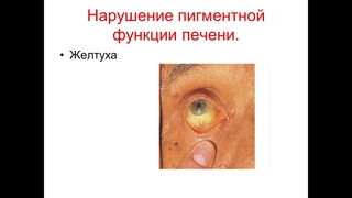1.Синдром портальной гипертензии. 2.Синдром печеночно-клеточной недостаточности