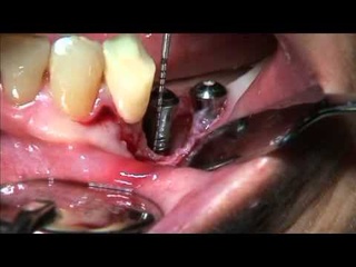 Debridement and bone regeneration at peri implantitis