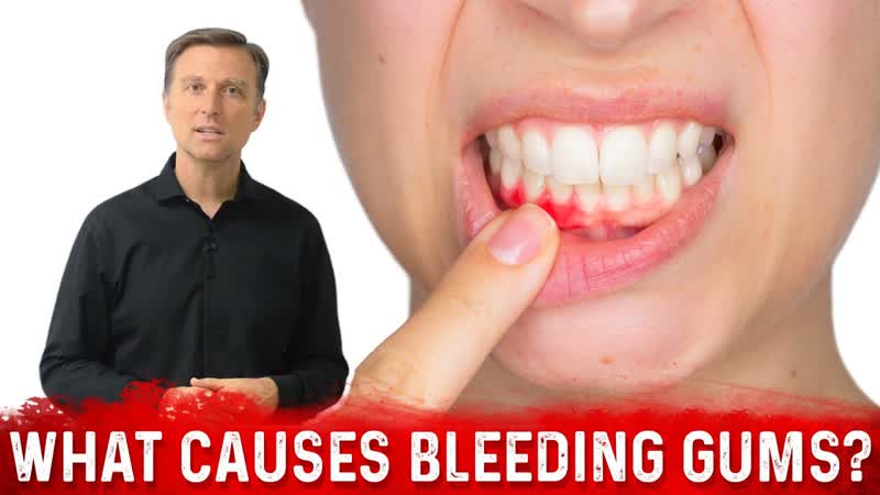 What Causes Bleeding Gums and How to Cure It Stop Bleeding