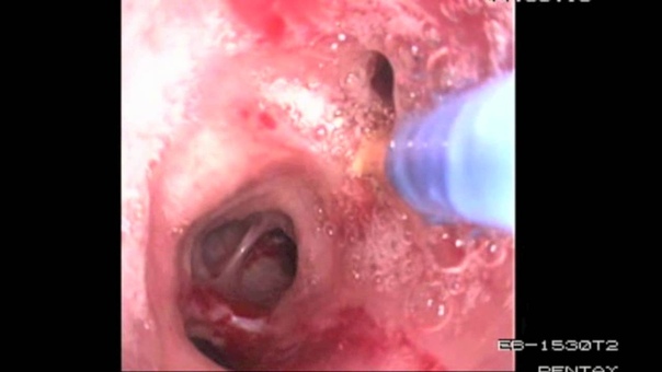 Bronchoscopy Procedure See inside the