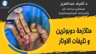 متلازمة دوبترين و تليفات الاوتار #دكتور_أش