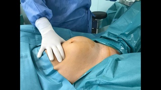 Huge uterus with bilateral endometriomas - Safe Laparoscopy
