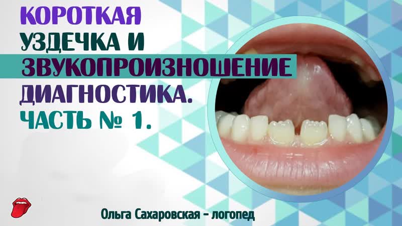 Короткая уздечка языка. Как влияет на произношение звуков