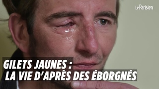 Gilets jaunes : la vie d’après des éborgnés