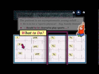 ECG Video-14 (Blog 117) - Brugada Syndrome ()