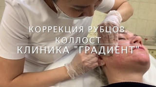 МЕЗОТЕРАПИЯ РУБЦОВ препаратом Коллост (Collost)
