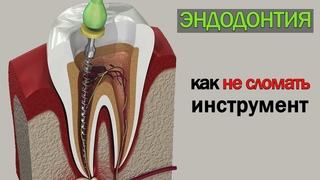 Как не сломать инструмент в корневых каналах зуба - эндодонтия причины поломок