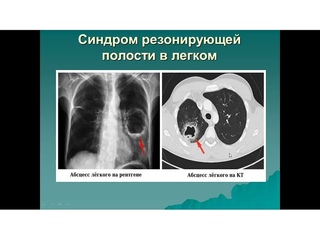 Основные синдромы пульмонологии.  Часть 1.