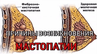 Причины возникновения мастопатии.  Схема лечения.