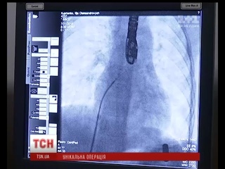 Трьом маленьким українцям інноваційно “полатали” серце без розтину грудної клітини